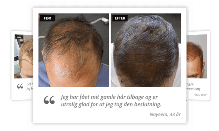 Før og efter en hårtransplantation i tyrkiet