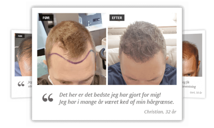 Før og efter en hårtransplantation