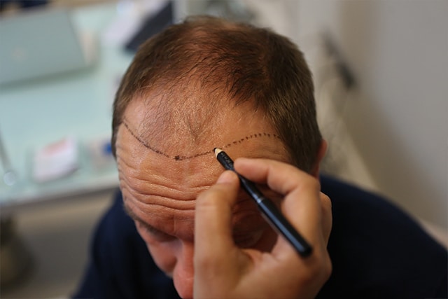 Hvad koster en hårtransplantation i Tyrkiet? Komplet prisguide 2026